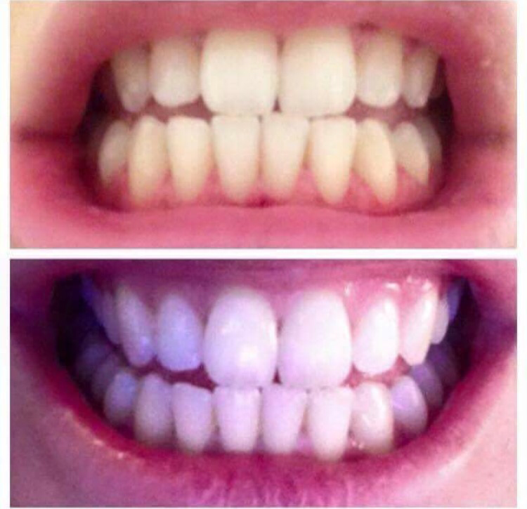 Non Perioxide Teeth Whitening